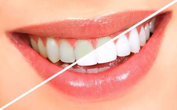 Professional Teeth Whitening: Is It Worth It?