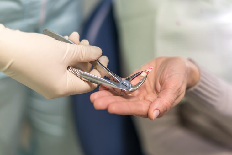 Pain-less Extraction & Third Molar Surgical Extraction